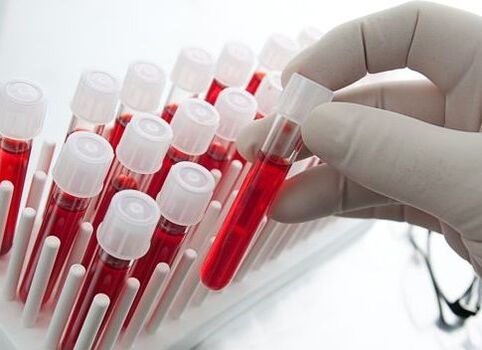 blood test for diagnosis of arthritis and arthrosis
