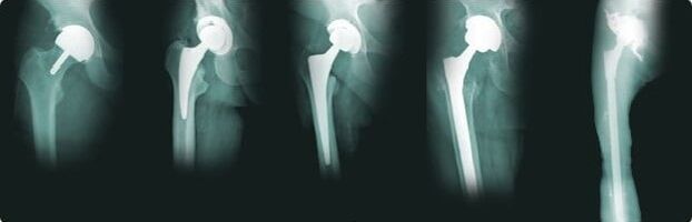 hip replacement options for osteoarthritis