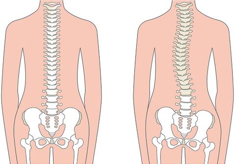 Low back pain due to spinal deformity, such as scoliosis