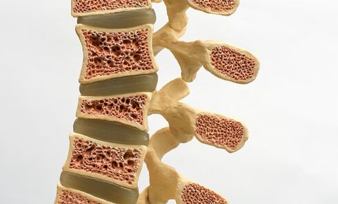 Osteoporosis is one of the causes of lower back pain