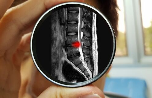 The consequence of neglecting pain in the lower back can be a herniated disc. 