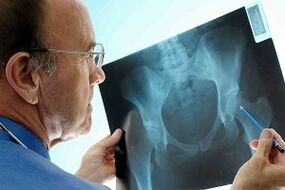 Hip Arthrosis on X -Ray