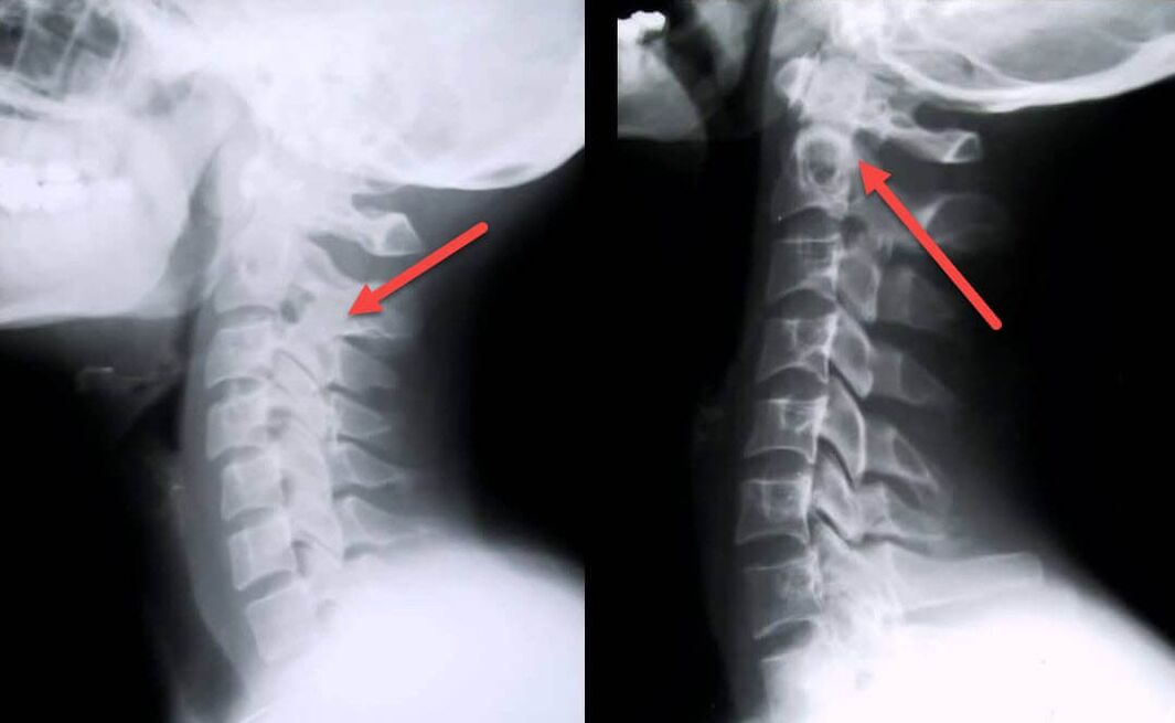 Manifestations of osteochondrosis of the cervical vertebrae on an X-ray