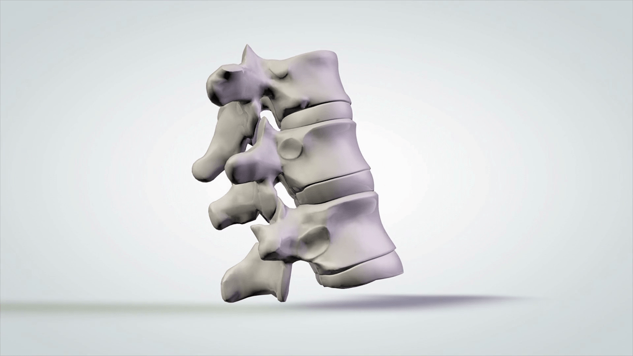 damage to the spine due to cervical osteochondrosis